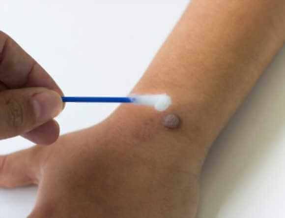 Essential Oils For Warts